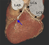 Coronary Artery 2 Figure 1