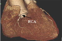 Coronary Artery 2 Figure 4