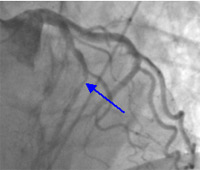 Coronary Artery 2 Figure 5