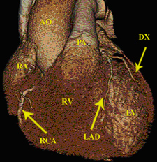 Coronary Artery figure 1