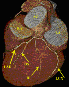 Coronary Artery Figure 2