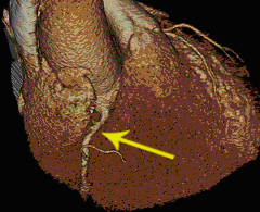 Coronary Artery Figure 3
