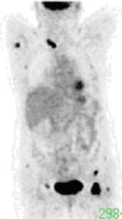 Breast Cancer Figure 1