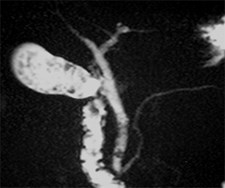 Magnetic Resonance Cholangiopancreatography Figure 1